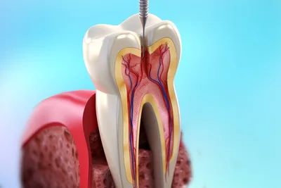 Клинический случай повторного лечения корневых каналов зуба 2.6 |  Эстетическая стоматология в Санкт-Петербурге Кирилла Костина
