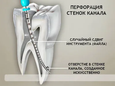 Лечение каналов зуба в Москве — цена эндодонтического лечения в семейной  стоматологии OneDent