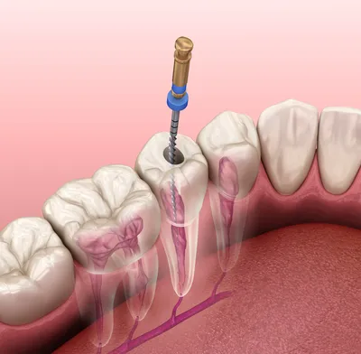 Перелечивание каналов зуба: причины, признаки и возможные осложнения