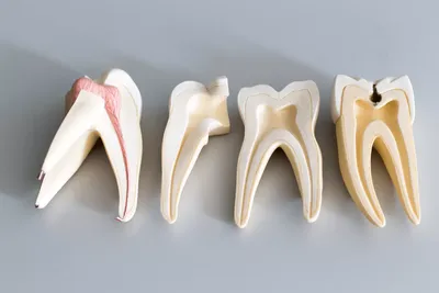 Повторное эндодонтическое лечение каналов зуба при воспалении пульпы