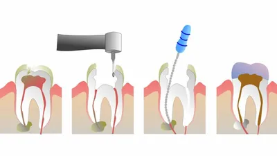 Лечение перфорации корня зуба