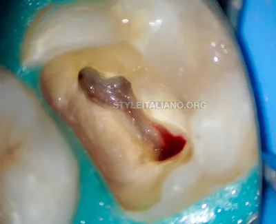 Распломбировка каналов. Перелечивание каналов зуба в Уфе |  Стоматологическая клиника «Маэстро»