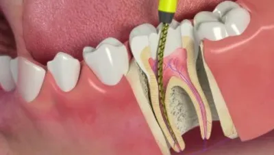 Что такое каналы зубов? | Немецкая стоматология доктора Гроссманна