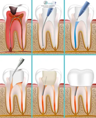 Перелечивание корневых каналов зуба, цены в Москве