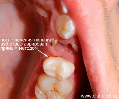 Лечение корневых каналов зубов под микроскопом в Минске, цена | Эндодонтия  зубов