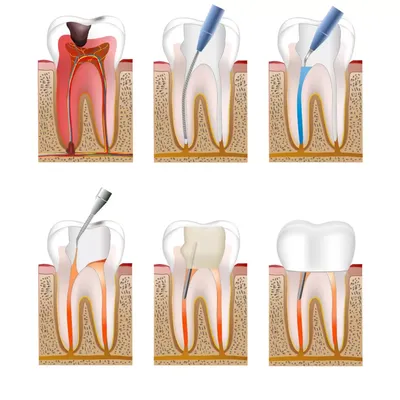 🚩 Надежное лечение каналов опытными докторами в стоматологии Беомед
