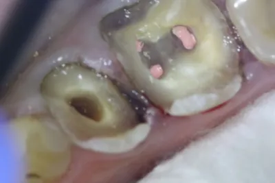Лечение каналов зуба — этапы, фото, почему болит зуб после лечения каналов  — Startsmile