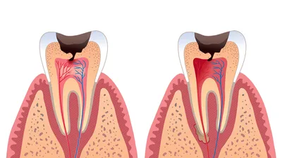 Лечение каналов зуба по доступной цене в Екатеринбурге. Лечение  периодонтита зуба, зубных каналов по недорогой стоимости. Периодонтит и  стоимость его лечения в стоматологии Приоритет