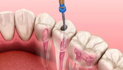 Первичное и повторное лечение каналов - быстро и без боли! Цена под ключ,  запись на приём, отзывы