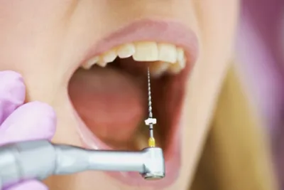 Лечение корневых каналов - DentalWood