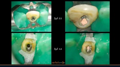 Сколько каналов в зубе - подготовка к лечению брекетами