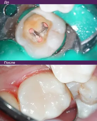 Как проводится лечение корневых каналов зуба?