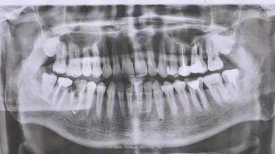 Клинический случай - протезирование зуба 27 (установка керамической коронки  E-Max)» — Яндекс Кью