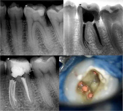Лечение неполного пломбирования корневого канала - Радент