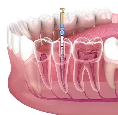 Безболезненное удаление зубного нерва по доступной цене в Красногорске