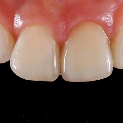 Перелечивание Каналов Зуба — Шанс Сохранить Зуб. (2024)