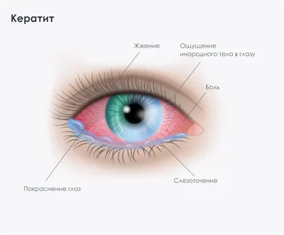 Кератит - причины появления и лечение заболевания