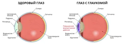 Глаукома, глаукома симптомы