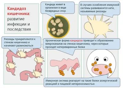 Грибок в интимной зоне: заболевания, лечение, препараты