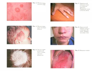 Как избавиться от перхоти, вызванной грибком кожи головы: эффективный  шампунь от сухой перхоти для лечения кожи головы