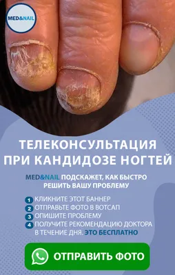 Кандидоз кожи и ногтей фото фото