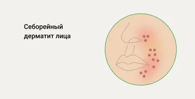 Грибковые дерматиты