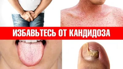 Лечение грибка ногтей лазером Киев, Позняки - Цены в NeoVita