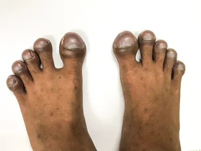 Восстанавливающий мягкий крем для ногтей, удаление онихомикоза пальцами ног,  противогрибковая инфекция, паронихия, антибактериальная мазь для лечения  грибка ногтей | AliExpress