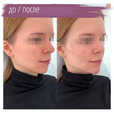 Контурная пластика филлером AestheFill в Москве — цена в клинике Ланцетъ