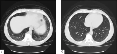 Panniculitis in the practice of an internist and a dermatologist (a  lecture) - Egorova - Consilium Medicum