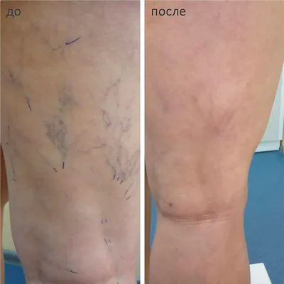 Фотографии до и после лечения сосудистой сетки на ногах на аппарате M22,  проводим в клинике Premium Aesthetics