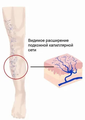 Лазерное удаление сосудистых звездочек на ногах | Медицинский центр  ФлебоПлюс