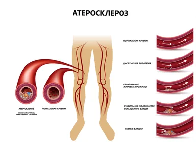 Варикоз на ногах, как избавиться? | Блог Daily Medical