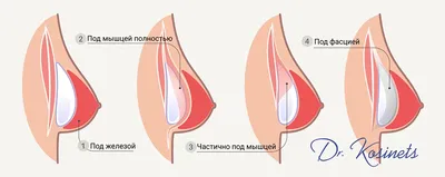 Какие бывают импланты? Откуда появился миф о лопающихся имплантах? |  Семейная Бьюти | Дзен