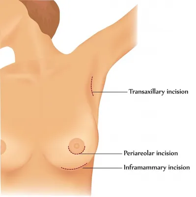 Увеличение/уменьшение груди, реимплантация - Дантист Магадан