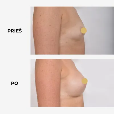 Каплевидные постоперационные грудные имплантаты из пищевого силикона  имитация груди подкладки против уплотнения имитация груди | AliExpress
