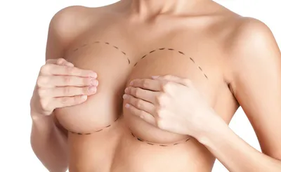 Увеличение груди с помощью имплантов - Grožio Akademija