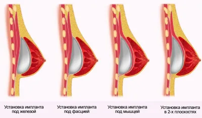 Каплевидный имплант груди | Пикабу