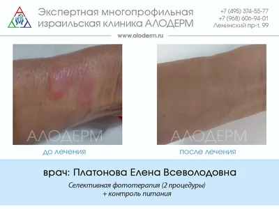 Лечение псориаза в Москве - фото до и после | Клиника АЛОДЕРМ Москва