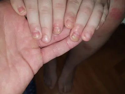Лечение псориаза кожи рук в клинике в Москве