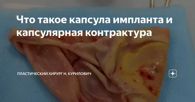 Что такое капсула импланта и капсулярная контрактура | Пластический хирург  Н. Курилович | Дзен