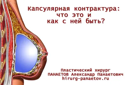 Капсулярная контрактура: что это и как с ней быть? | ПАНАЕТОВ Александр  Панаетович