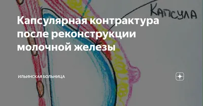 Капсулярная контрактура