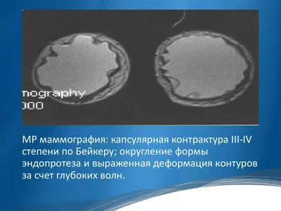 ОНКОЛОГ | МАММОЛОГ | on Instagram: \"📌Анапластическая крупноклеточная  лимфома или имплант-ассоциированная лимфома (ИАЛ) — редкая форма лимфомы,  которая может возникать у некоторых женщин после установки грудных  импланты. Важно понимать, что ИАЛ