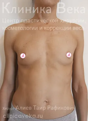 Осложнения после увеличения груди: СЕРОМА, КАПСУЛЯРНАЯ КОНТРАКТУРА /  KAMINSKYI - YouTube