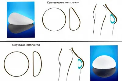 КЛОВЕРМЕД против рака груди on Instagram: \"После реконструктивной операции  с применением импланта, через некоторое время, вокруг него начинает  образовываться капсула из соединительной ткани. Но при определенных  условиях, эта капсула может уплотняться и