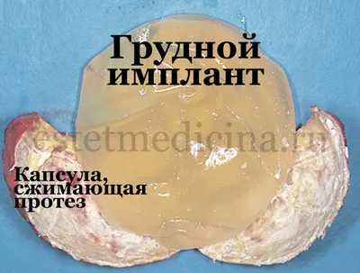 Фиброзно-капсулярная контрактура после маммопластики: фото, признаки.  Реэндопротезирование, замена имплантов | Интернет-журнал Estetmedicina.ru