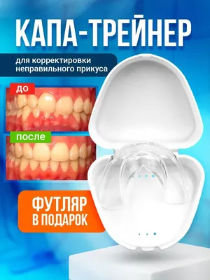Стоматологические капы для детей, исправление прикуса, выравнивение зубов:  цены детской капы для зубов | НоваДент