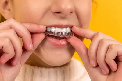 Капы для отбеливания зубов: нюансы применения, плюсы и минусы | Healthy  Dent (Киев)