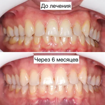 Элайнеры (капы) для выравнивания зубов - цена установки в стоматологии  Новодент